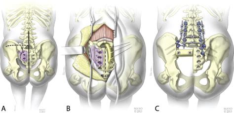 Hemipelvectomy: high.